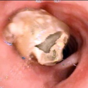 Stent Traqueal. Incrustação de Secreções