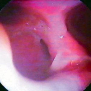 Fístula Traqueobroncoesofágica