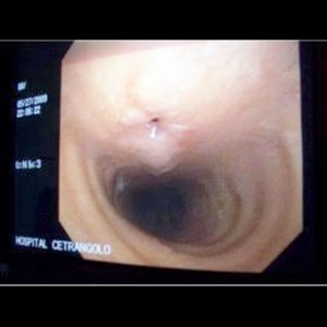 Fístula Traqueal