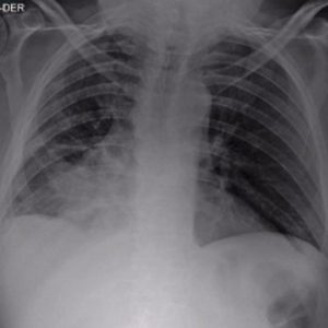 Stent Brônquico