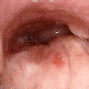 Tumor Brônquico
