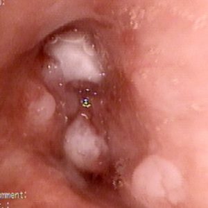 Carcinoma Brônquico
