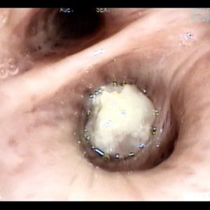 Tumor de Superfície Necrótica