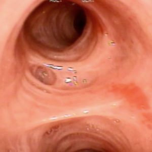 Atrofia da Mucosa