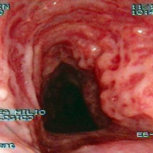 Traqueopatia Osteocondroplástica