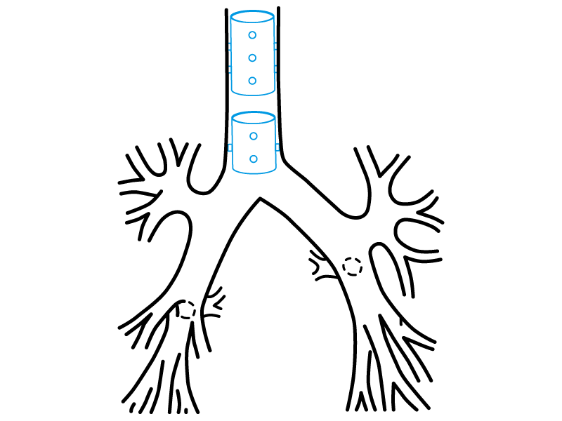 Suggested-use diagram in the tracheal tree