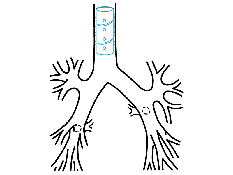 Esquema de uso sugerido do Stening&reg; Helicoidal na &aacute;rvore traqueal