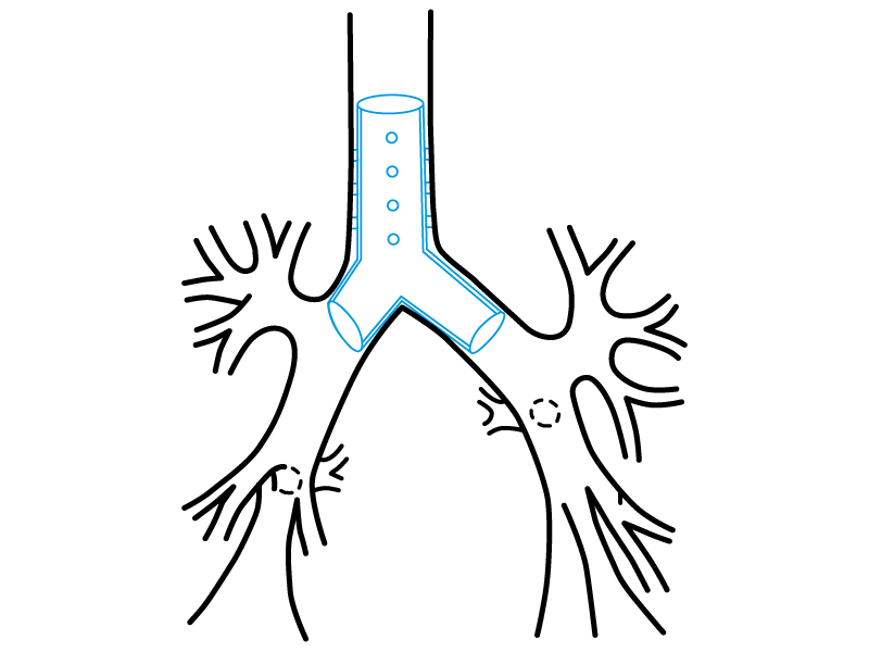 Tracheal tree suggested use diagram