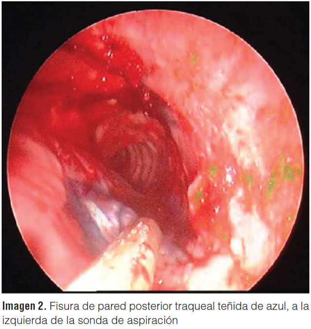 Fissure of the posterior wall with esophageal communication demonstrated by the methylene blue test