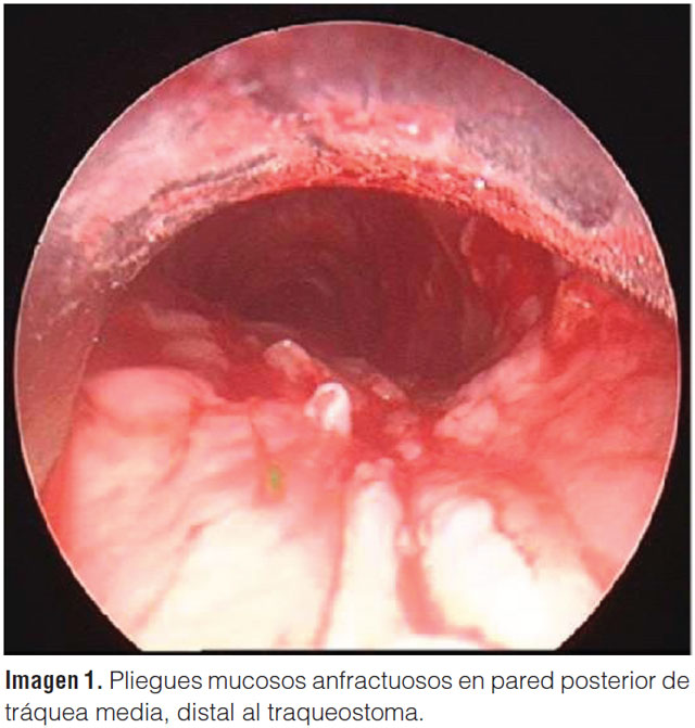 Longitudinal folds and grooves on the posterior tracheal wall